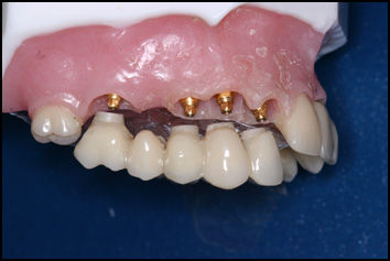 Dental Bridges