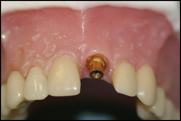 single tooth implant