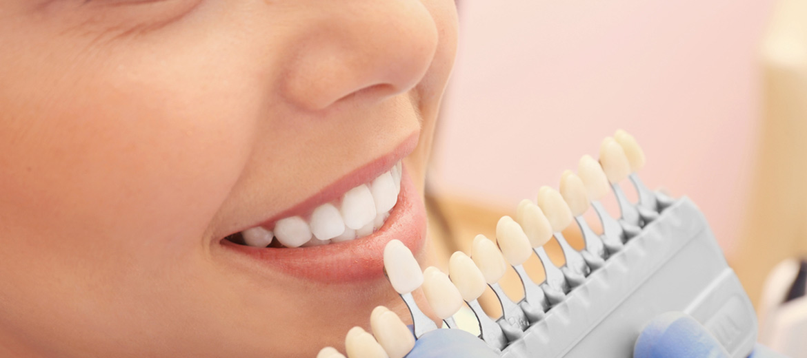 Surrey Implant Services Tooth Colour Matching